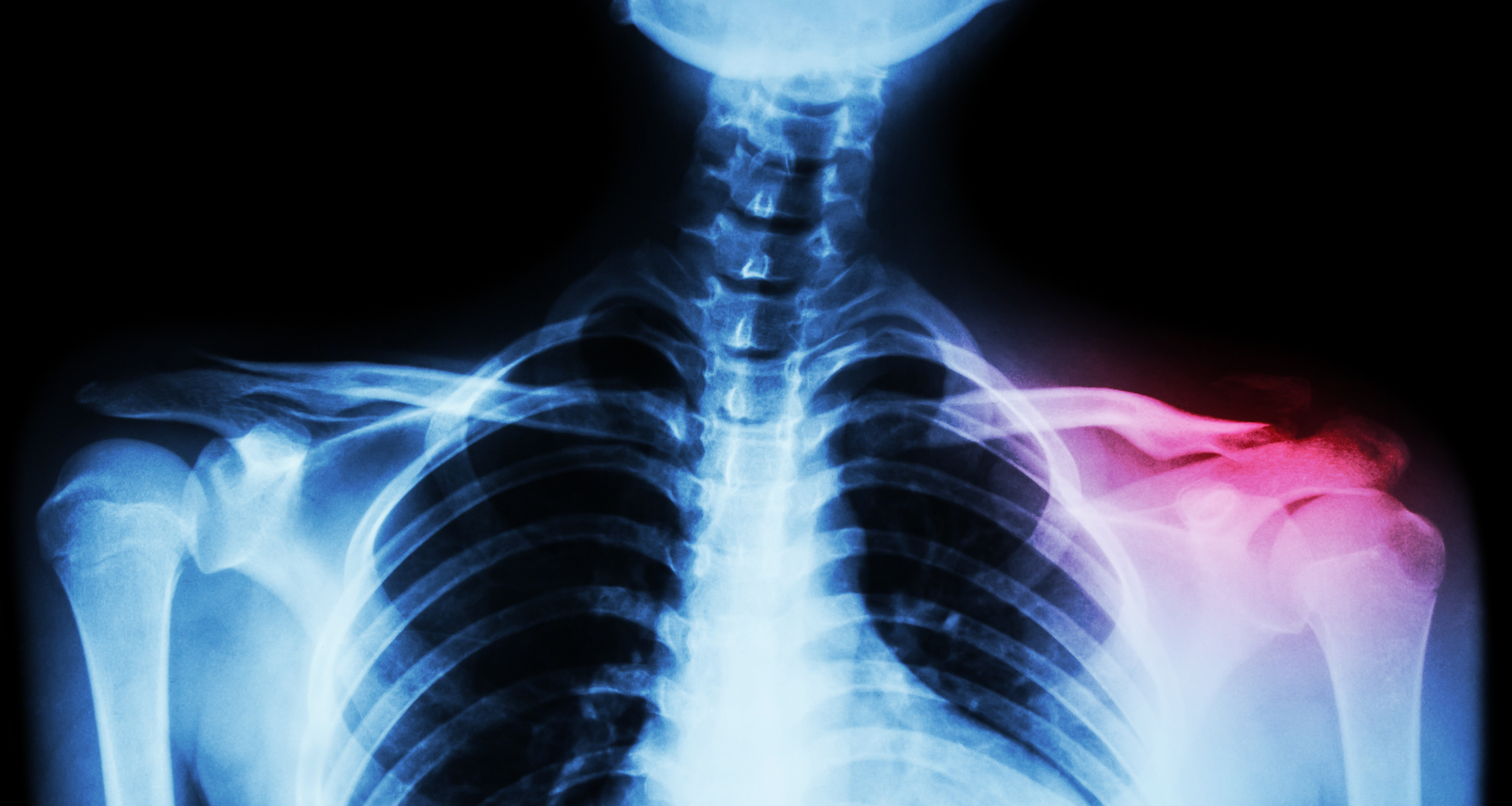 Distal Clavicular Osteolysis Columbia Advanced Chiropractic Llc